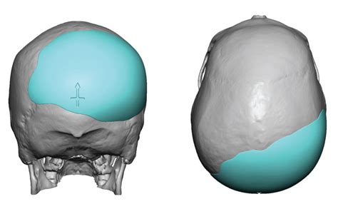 Occipital Plagiocephaly Skull Implant Design Dr Barry Eppley