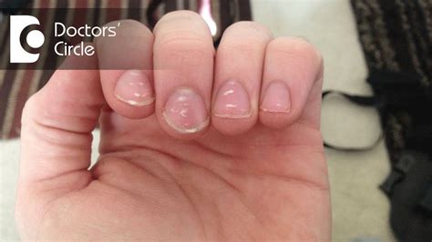 What Are The Top 8 Causes Of White Spots On Nails Healthmed Org Vrogue
