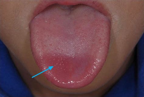 Spots On Tongue Causes And When To See A Doctor Ed8