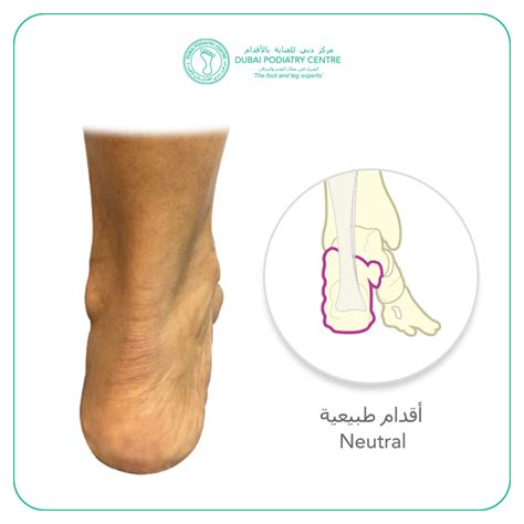 Achilles Tendinitis And Heel Bone Pain Dubai Podiatry Centre