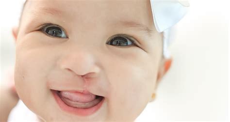 Cleft Lip And Cleft Palate Treatment For Babies Feeding Baby With A Cleft