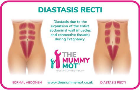 If you have diastasis recti or abdominal separation, you want to avoid adding any additional pressure to your midline. Diastasis Recti After Pregnancy - The Mummy MOT®