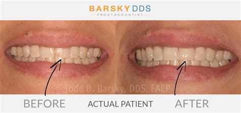 How To Fix A Chipped Or Broken Tooth With Dr Barsky In Miami