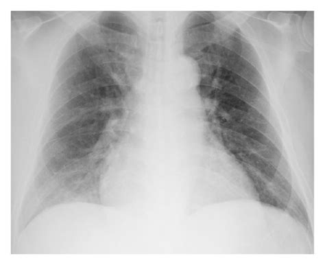 Chest X Ray Shows Cardiomegaly And Pulmonary Vascular Congestion
