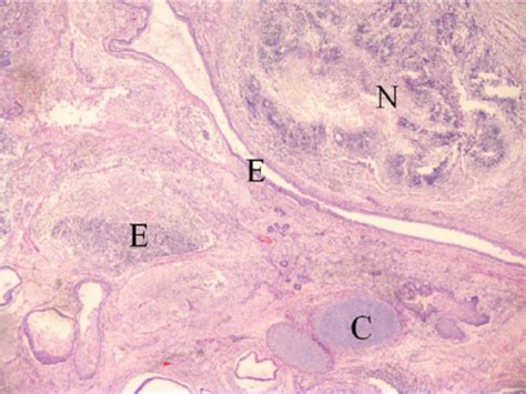 Immature Ovarian Teratoma With Glandular Epithelium And Squamous E