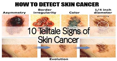 10 Telltale Signs Of Skin Cancer