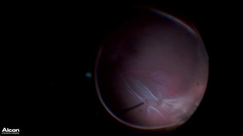 Utilizing A Large Radial Scleral Buckle To Repair A Retinal Detachment