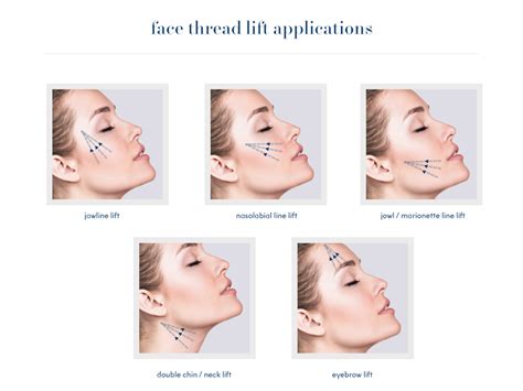 Face Thread Lift Mizu Aesthetic Clinic