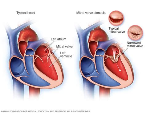 Mitral Valve Disease Cpr Acls Pals Certification In Manhattan Ny