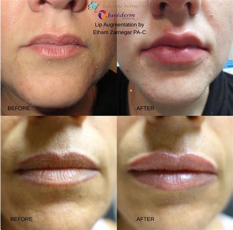 Juvederm Adds Volume To The Lips And Smooths Verticals Lip Lines Before After Photos Of
