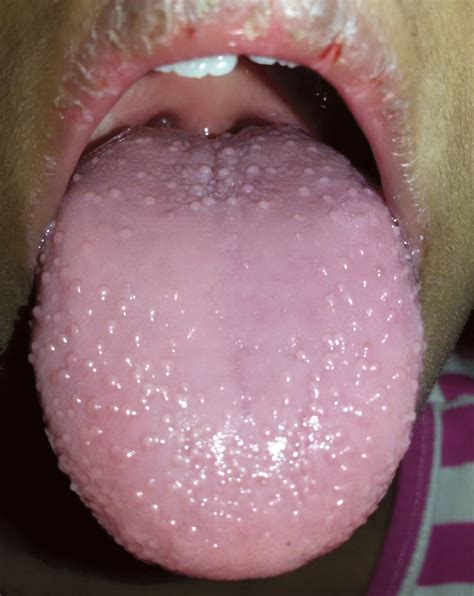Strawberry Tongue Nejm
