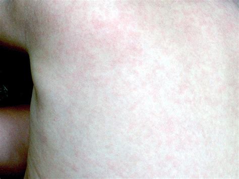 Roseola Rash Symptoms Pictures And Treatment Medical News Today