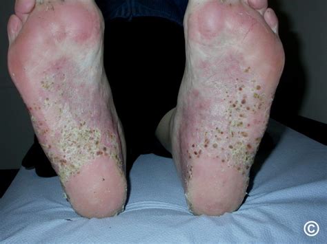 Pustular Psoriasis Foot