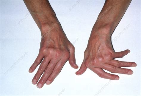Deformed Hands Due To Rheumatoid Arthritis Stock Image M1100269