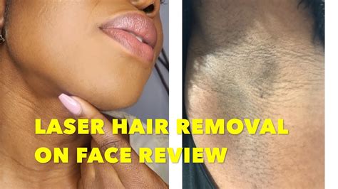 Laser Hair Removal For A Black Girl Does It Work Youtube