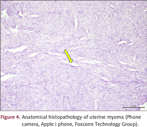 Figure From Giant Fibroepithelial Polyps Of The Vulva In A Woman With