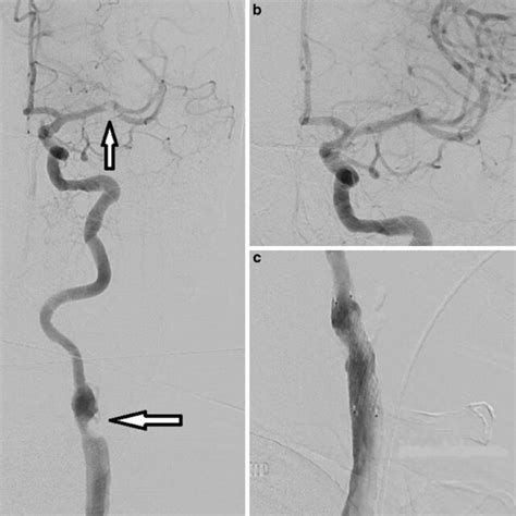 Patient With An Internal Carotid Artery Ica Stenosis On The Left Side