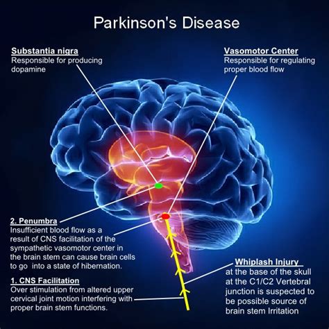 10 Best Images About Parkinsons Disease On Pinterest Car Crash
