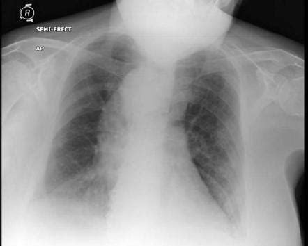 Right Sided Aortic Arch Radiology Reference Article Radiopaedia Org