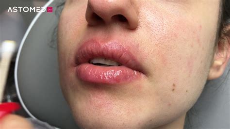 Ferulac Dubai Lips Peel Astomed Klinikutrustning Youtube