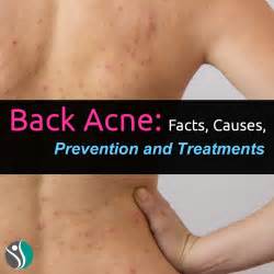Back Acne Facts Causes Prevention And Treatments Consumerhealthweekly Com