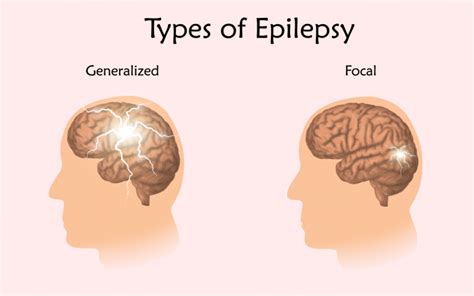 Epilepsy Symptoms Causes And Treatment Apollo Hospital Blog