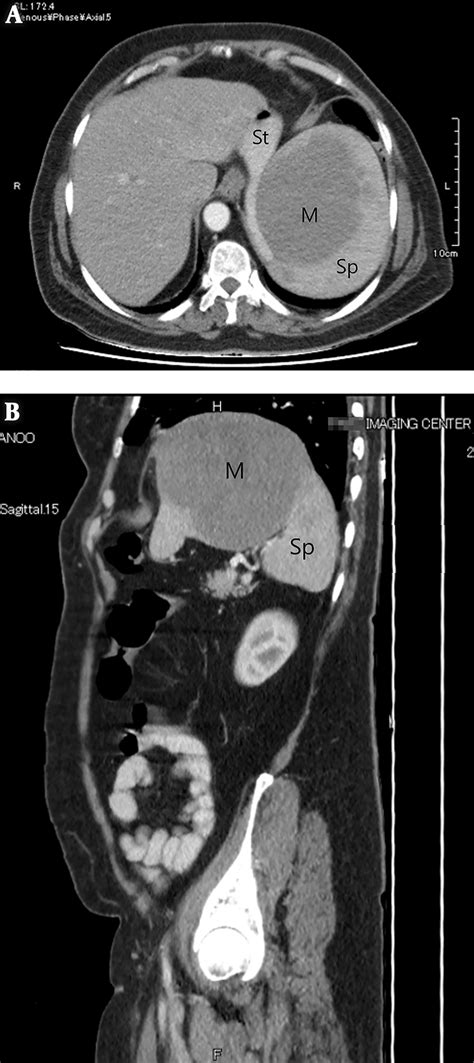 Axial A And Sagittal B Section Of The Abdominal Ct Scan