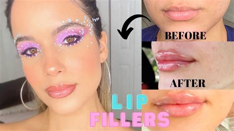 Lips Fillers Experience Before Healing Process After 1 Ml Juvederm