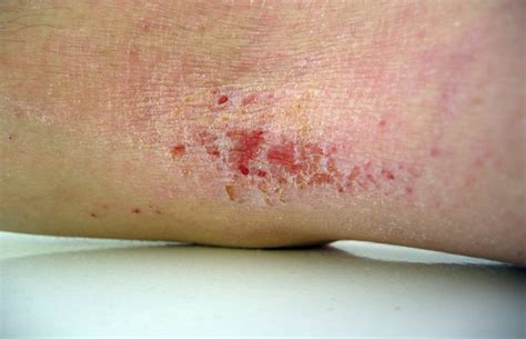 Eczema Can Be Worse For Adults Health24