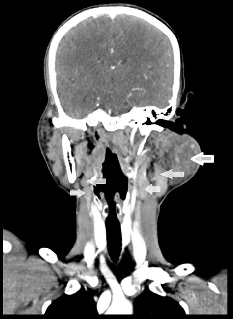 Coronal Reformatted Contrast Ct Image Of The Neck Reveals Heterogeneous