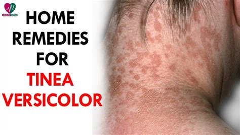 Home Remedies For Tinea Versicolor Health Sutra Youtube