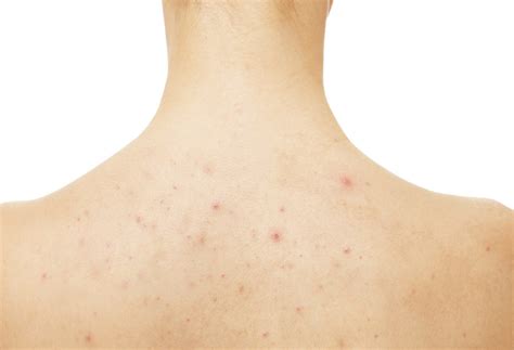 What You Need To Know About Back Acne Short Hills Dermatology