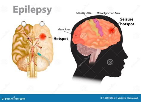 Medizinische Illustration Eines Gehirns Mit Epilepsie Vektor Abbildung