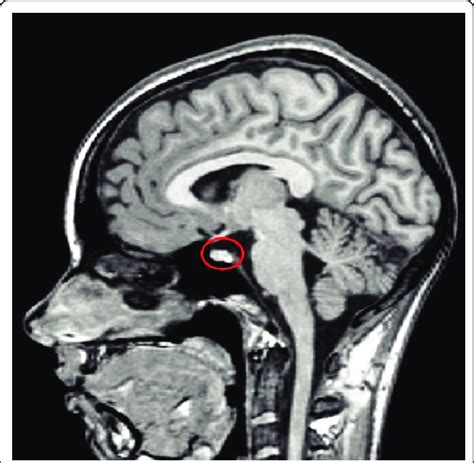 normal pituitary gland mri with contrast hot sex picture