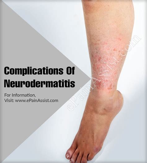 Neurodermatitis What It Is Causes Symptoms And Treatment