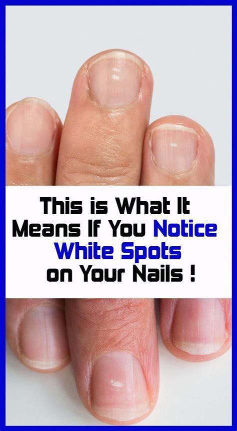 Cool White Spots On Your Nails Means Someone Likes You 2022 Fsabd42