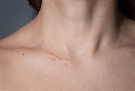 Laser Treatment For Scars Everything You Need To Know • Lynton Lasers