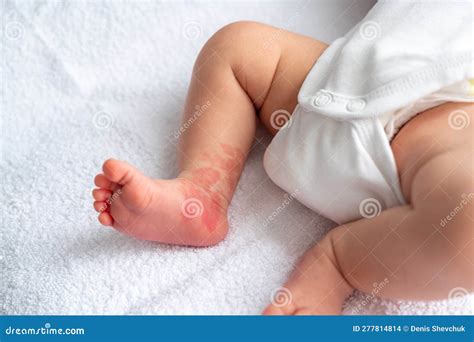 Hemangioma Red Birthmark On The Leg Of Newborn Baby Stock Photo Image