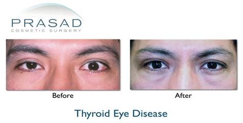 Thyroid Eye Disease Graves Disease Dr Prasad Ny