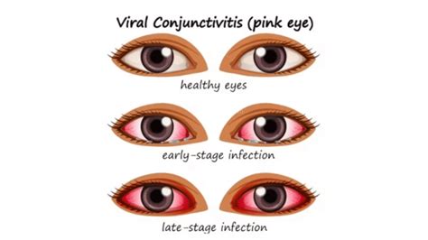 Conjunctivitis Causes How This Viral Eye Infection Spreads Treatment