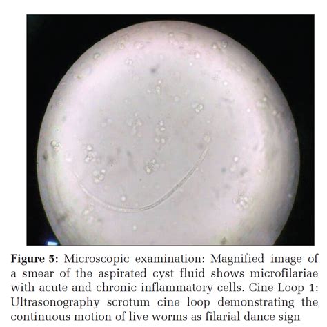 Retroperitoneal Cyst An Unusual Presentation Of Filariasis