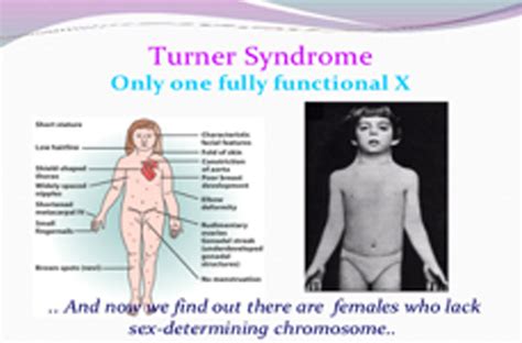 Turner S Syndrome