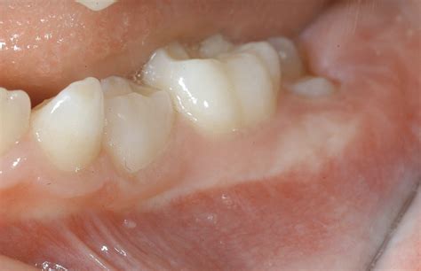 6 Year Old Molars Kiddies Dental Care