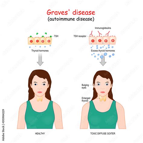 Graves Disease Toxic Diffuse Goiter Is An Autoimmune Disease That