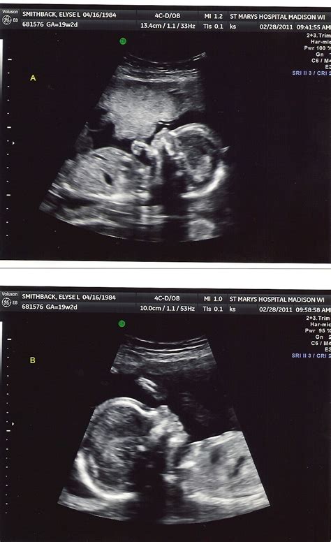 Baby Ultrasound Pictures Twins Get More Anythinks