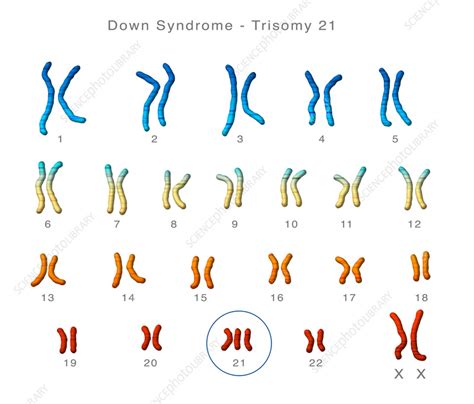 Down Syndrome Karyotype Illustration Stock Image C0555369 Science Photo Library