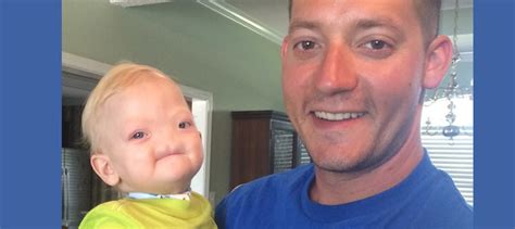 Father Writes Obituary As Toddler Who Was Born Without A Nose Dies At Age 2