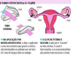 Arquivos método novo de laqueadura Conversa de Menina