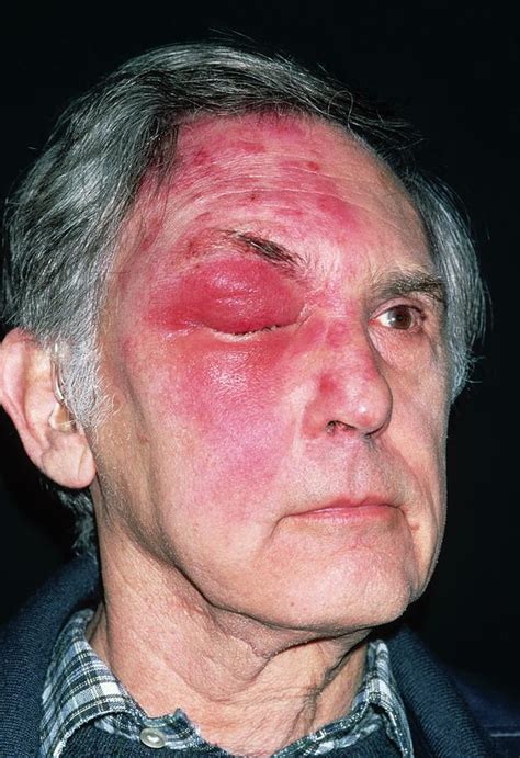 Shingles Attack On Head Of Elderly Male Photograph By Dr P Marazzi