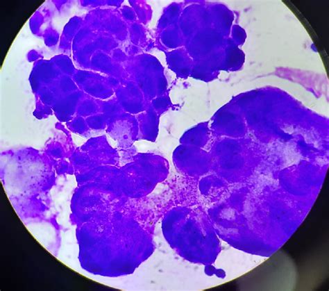 Ascitic Fluid Cytology